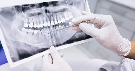 L'Endodontie